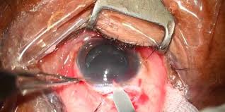 cataract surgery